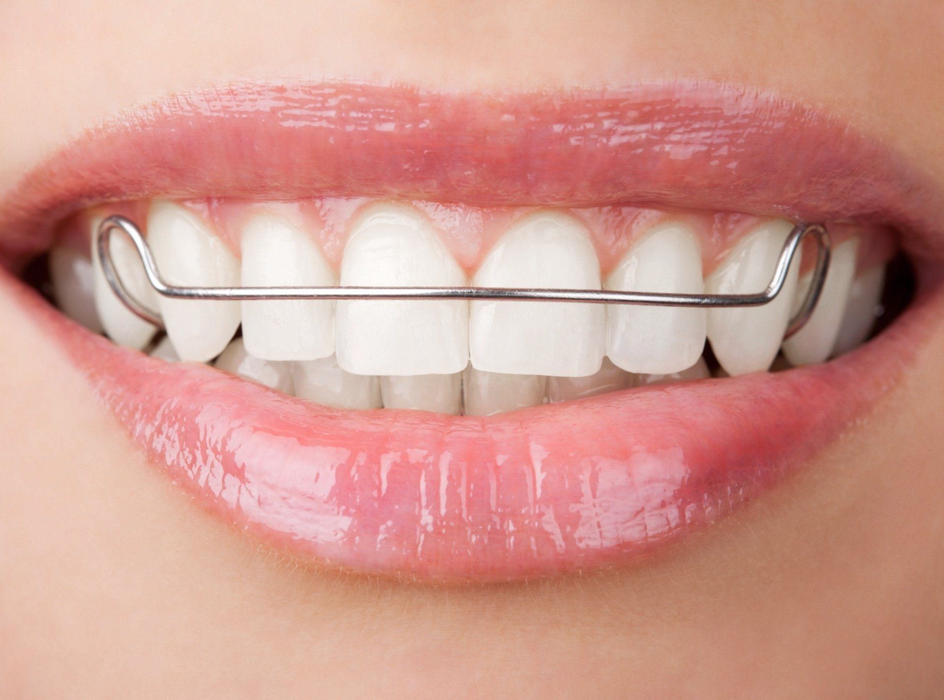 Close-up of a person's smiling mouth showing a metal permanent retainer on straight, white teeth.