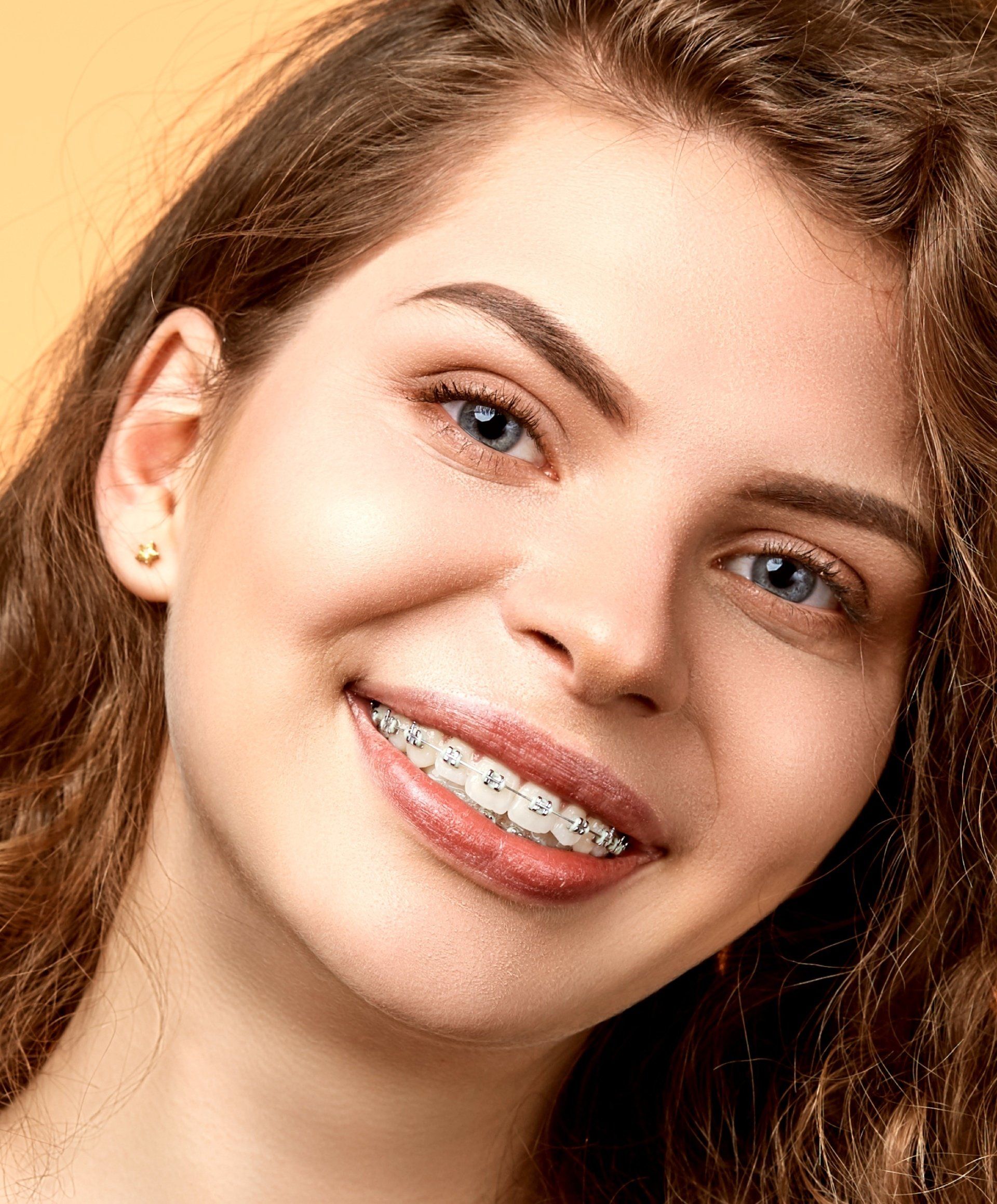 A close up of a woman with braces on her teeth smiling.