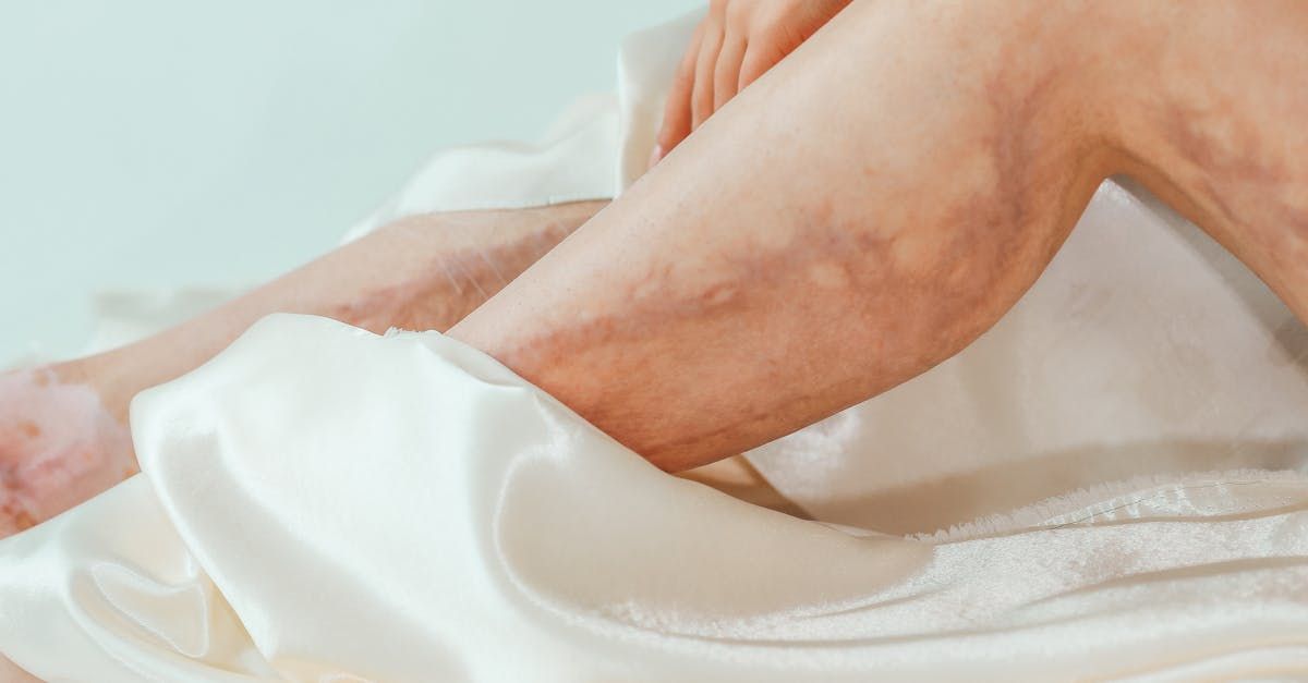 Une personne souffrant de varices aux jambes est assise sur un lit.