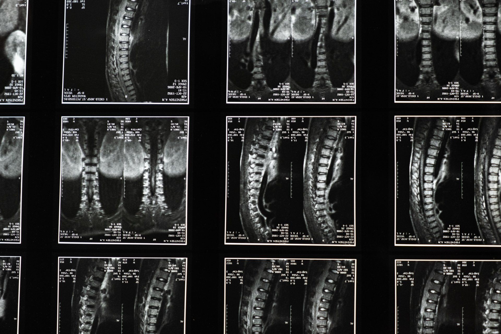 X-ray images showing possibly arthritic joints