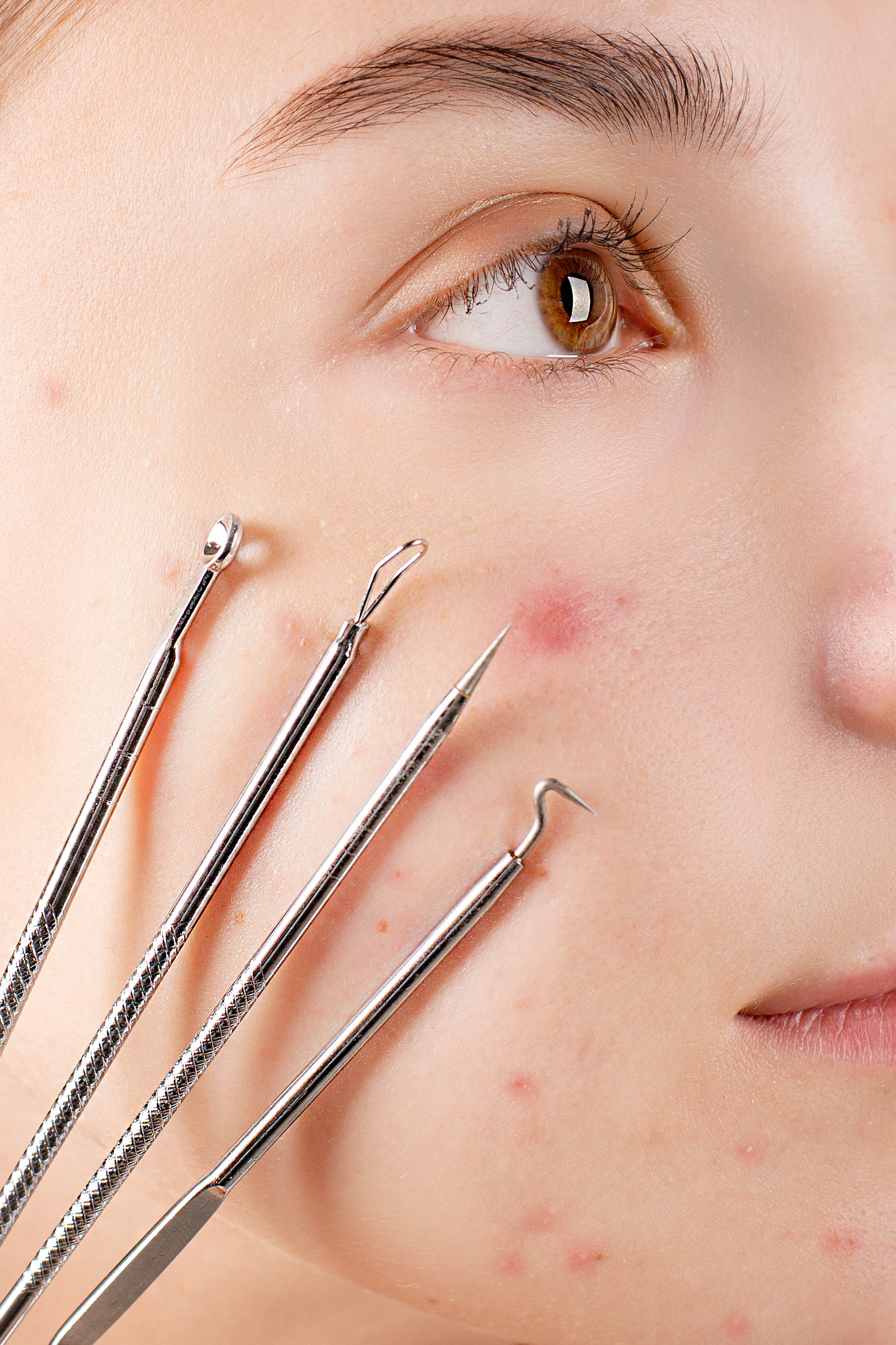 A Close Up Of A Woman 's Face With Acne And A Pair Of Tweezers