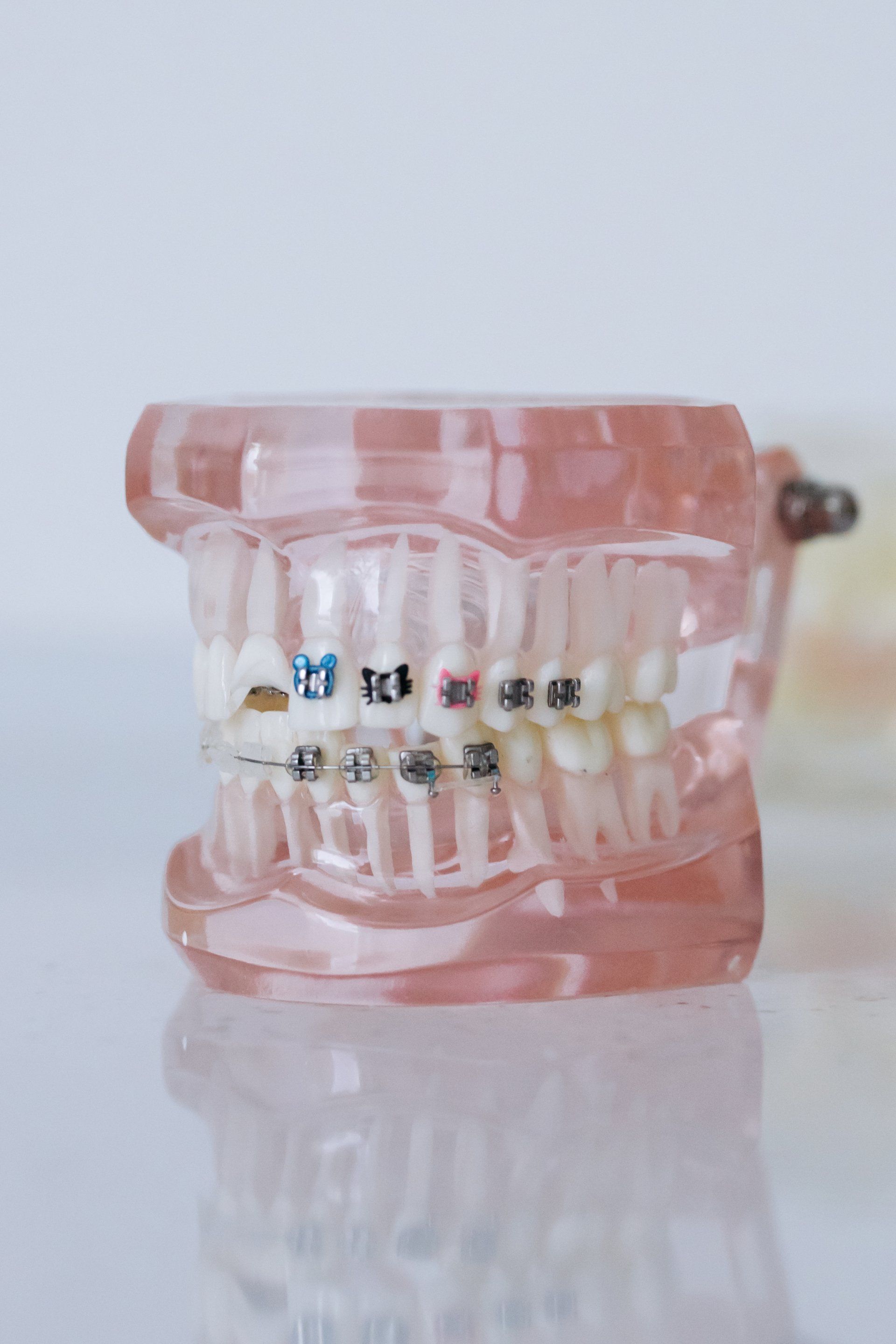 5 Things You Should Know About Braces: Traditional vs. Invisible