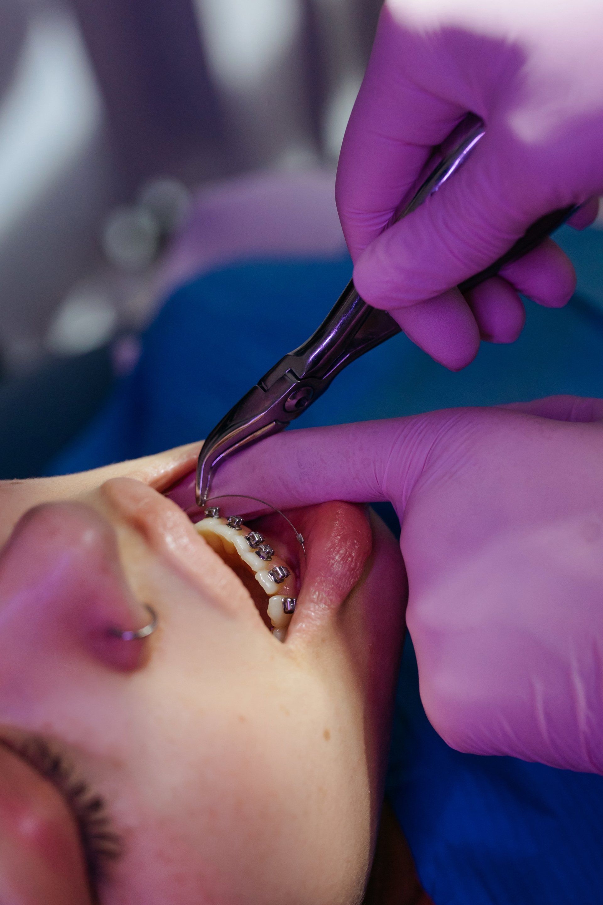 Dentist removing braces from patient's mouth with pliers. Pink gloves, blue background.