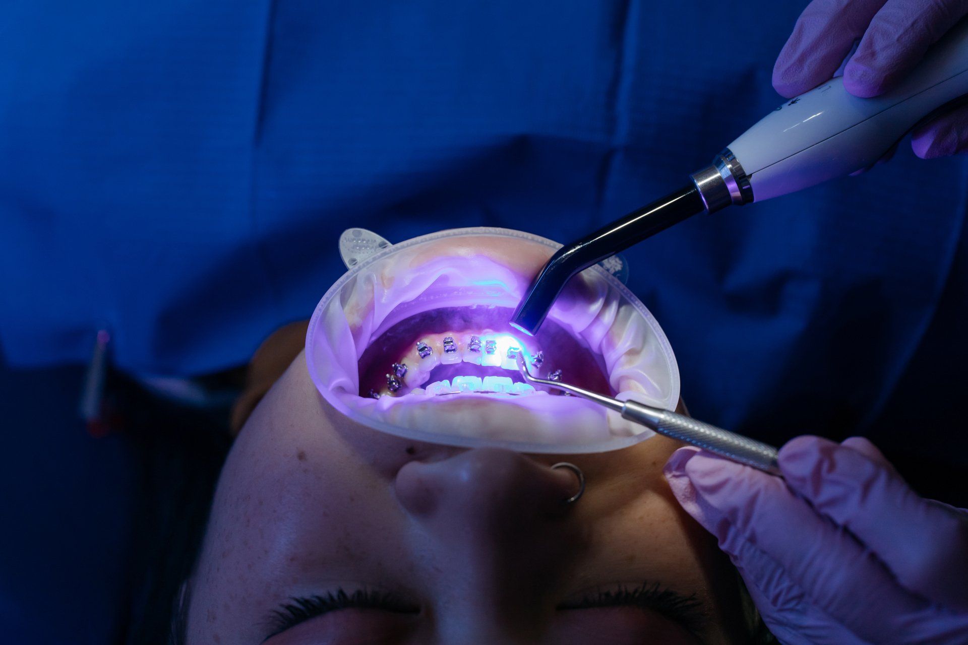 How Laser Dentistry Makes Teeth Whitening Simple