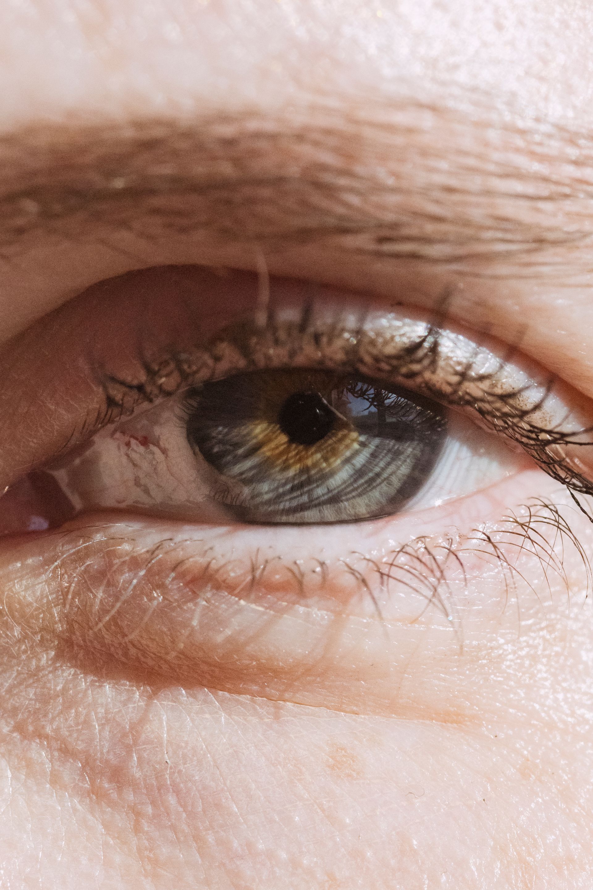 Cataract Surgery and macular degeneration.