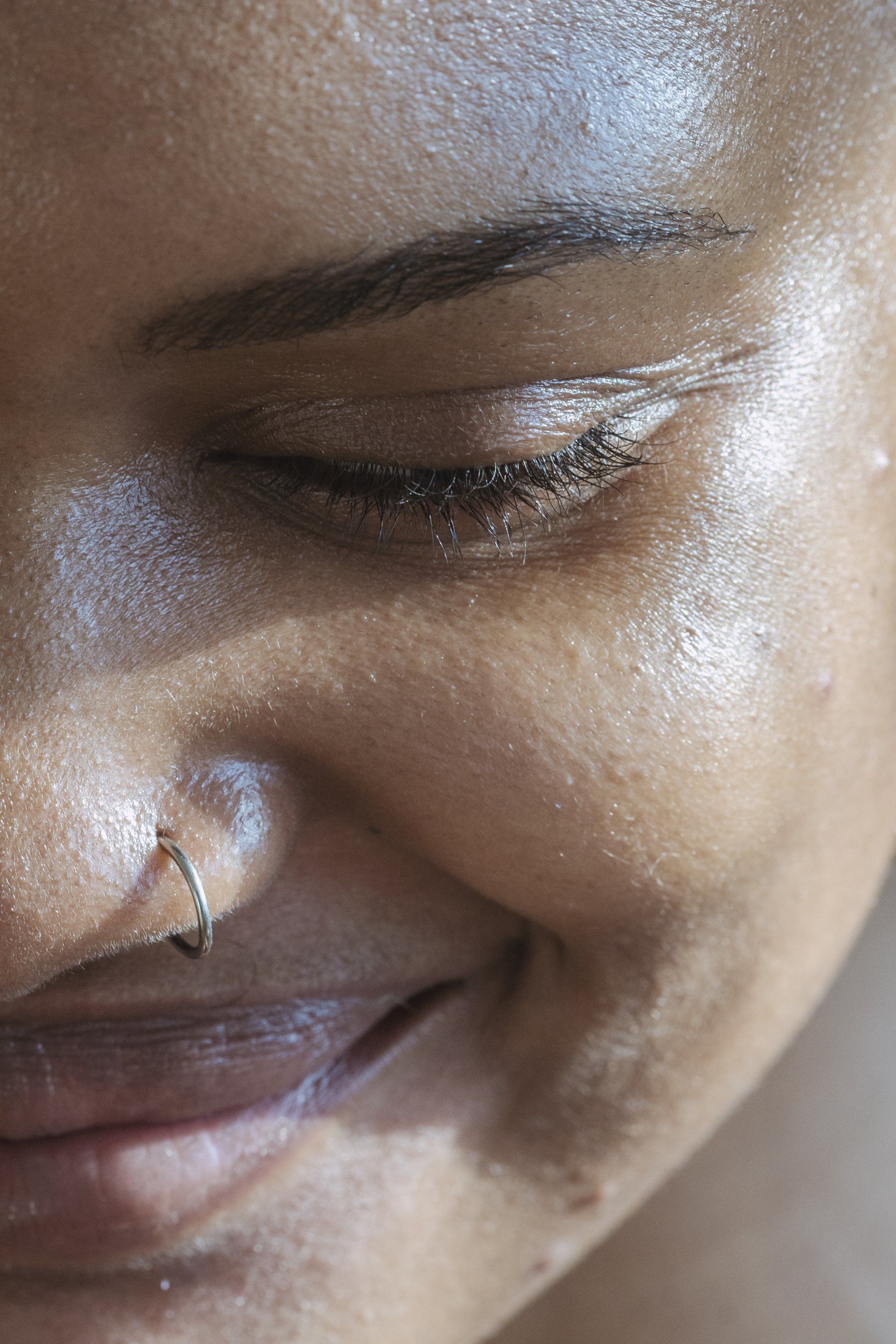 Close-up photo of a person's eyes with drooping upper eyelids and puffiness under the eyes.