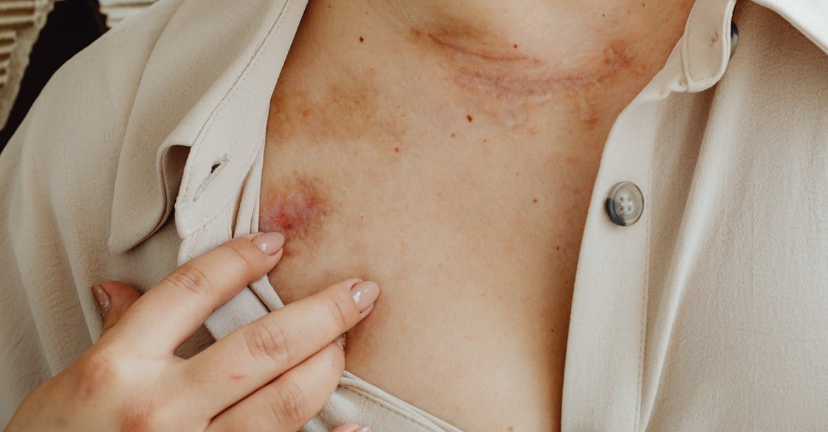 Bruises and scars on the chest as visible signs of personal injuries.