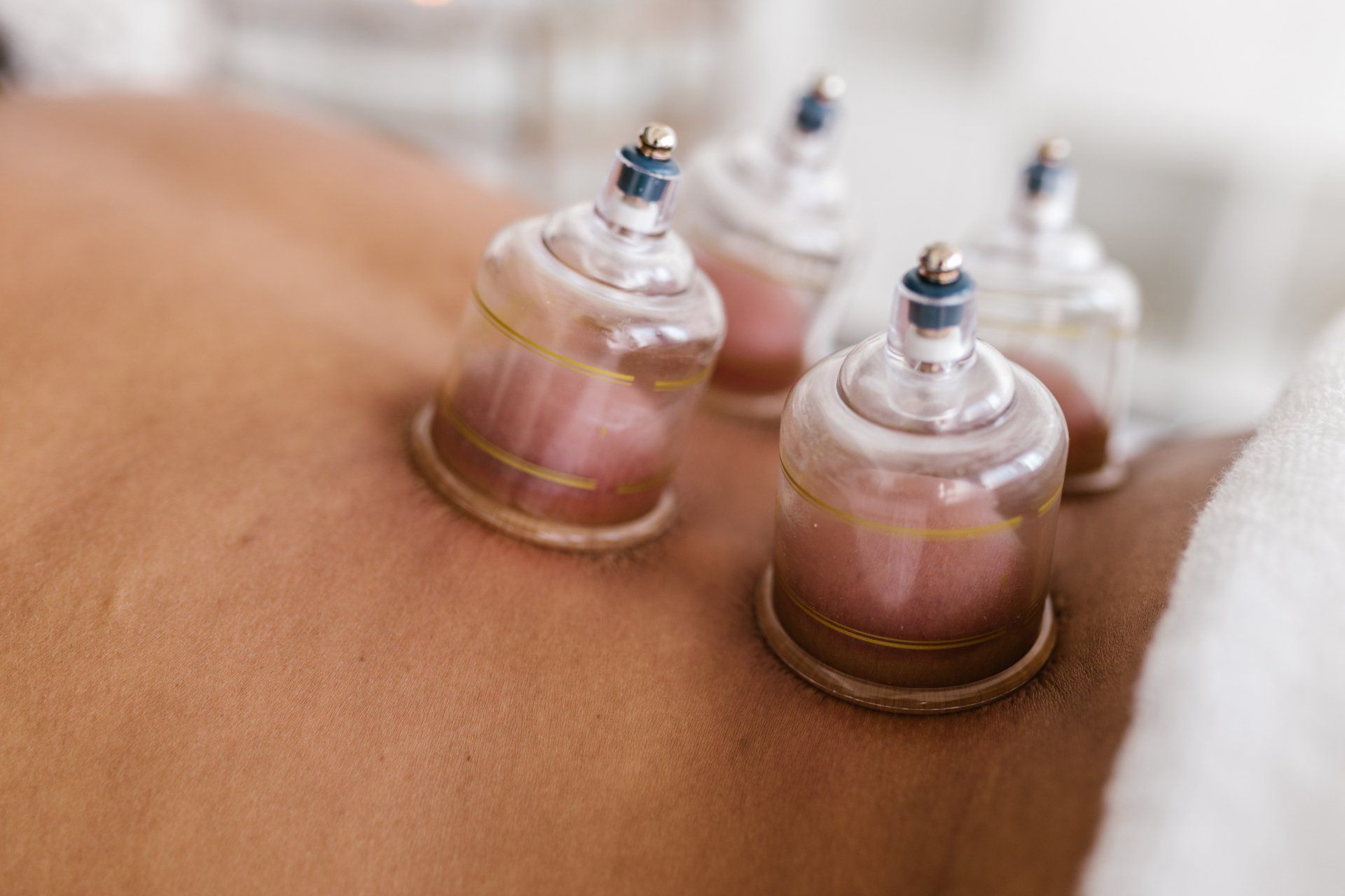 static and dynamic cupping