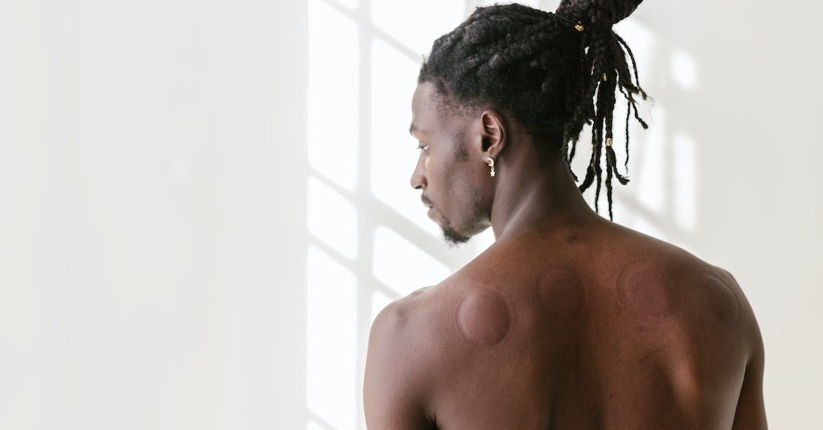 Man with Cupping Marks on Upper Back