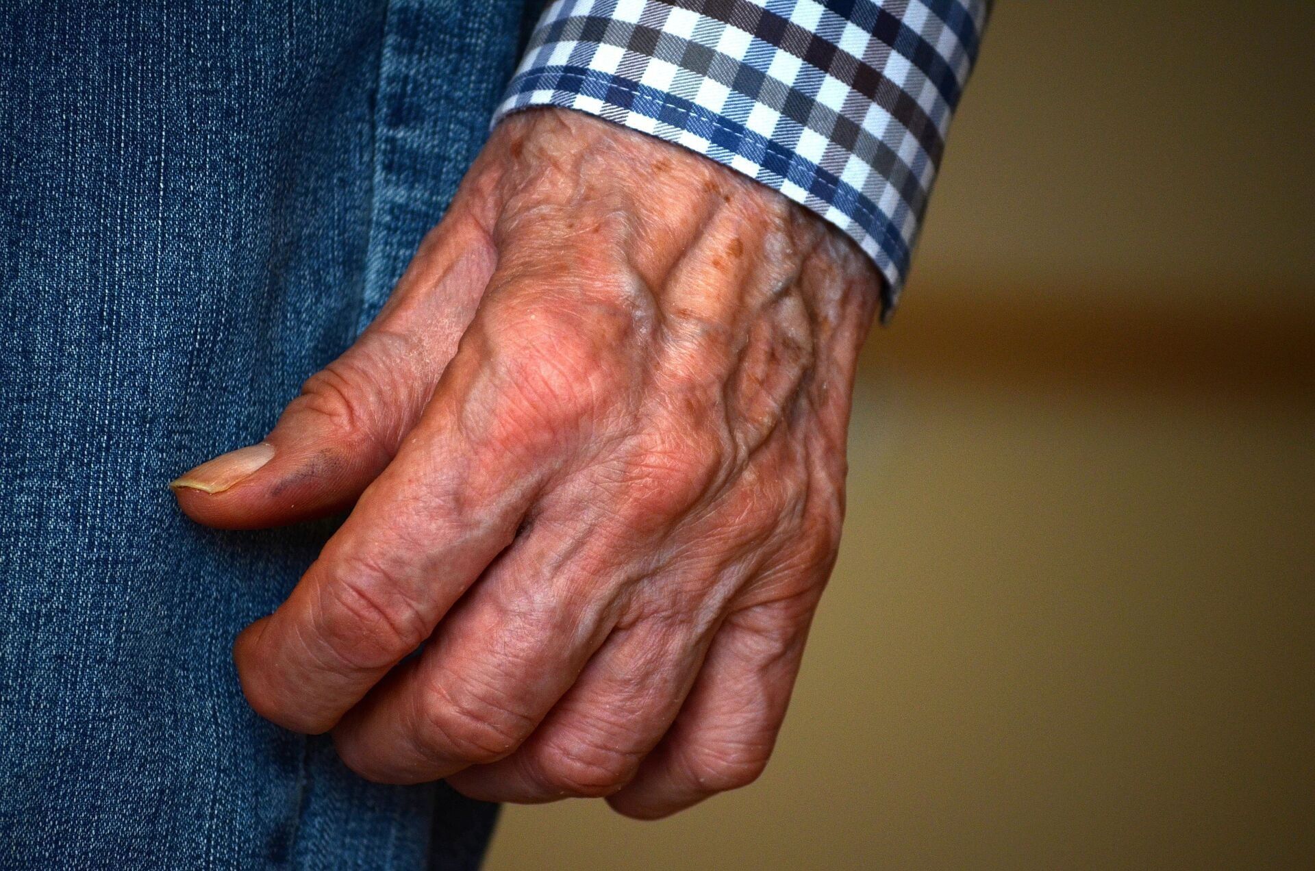 An elderly man's hand with severe arthritis.