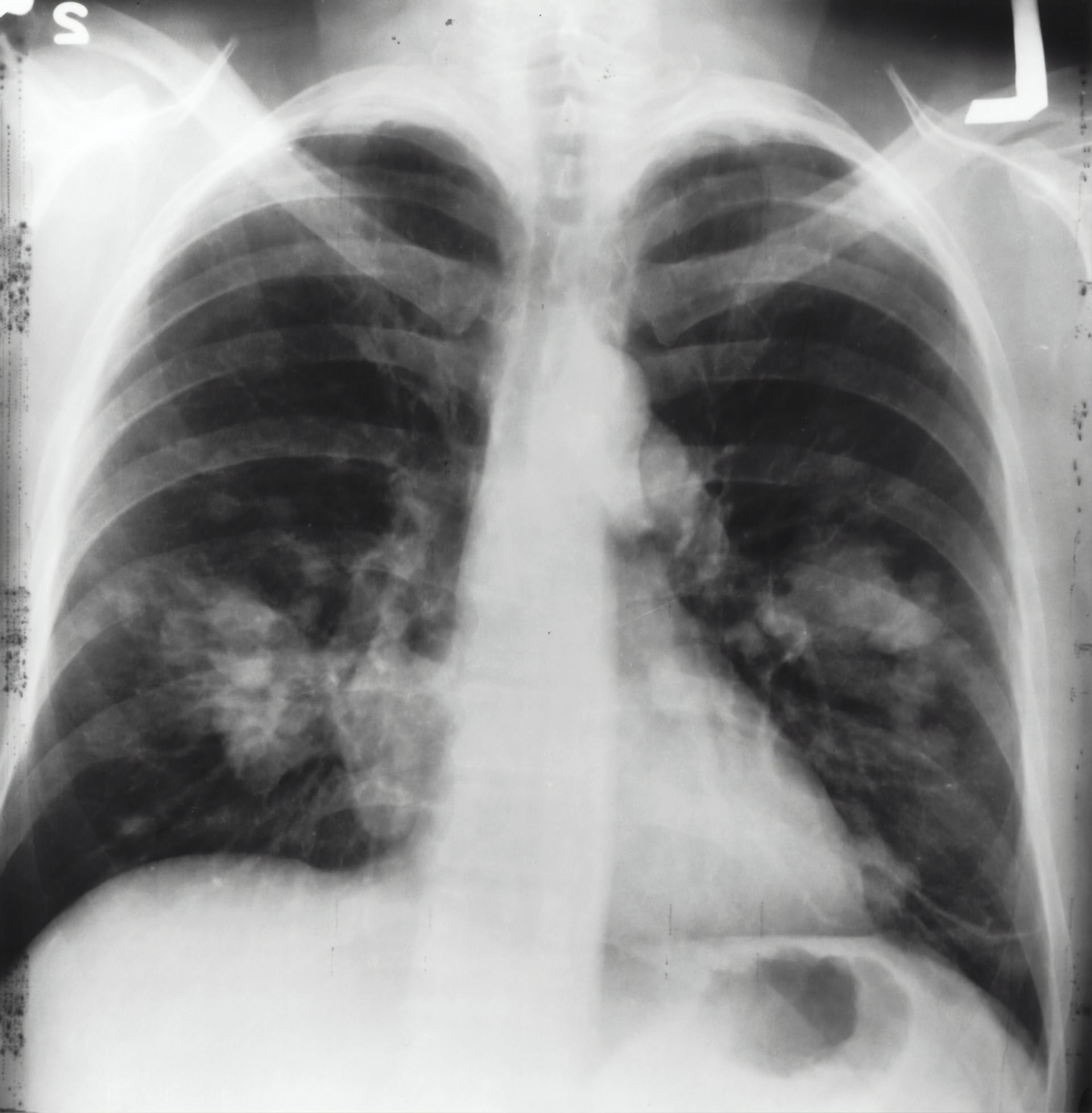 It is a black and white x-ray of a person 's chest.