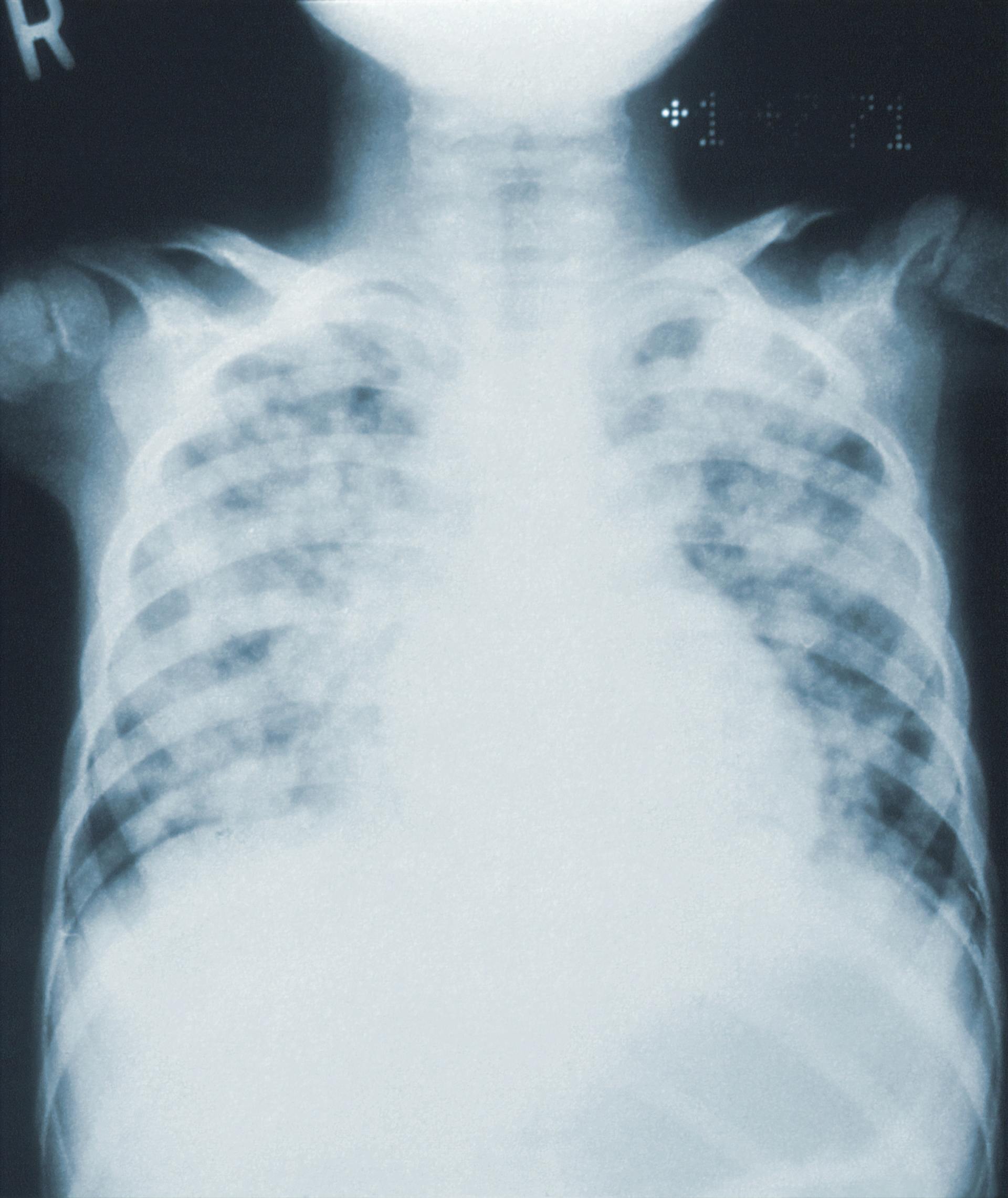 Chest X-ray of a child, showing a hazy, patchy pattern in the lungs, suggestive of a respiratory illness.